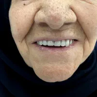 دندان مصنوعی + لابراتوار دندانسازی|خدمات آرایشگری و زیبایی|تهران, شهرک ولیعصر جنوبی|دیوار