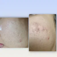 درمان تک جلسه ای