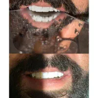 دندانپزشکی کامپوزیت ونیر فقط 9میلیون  اقساطی|خدمات آرایشگری و زیبایی|ارومیه, |دیوار