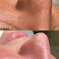فیشیال و پاکسازی پوست|خدمات آرایشگری و زیبایی|شیراز, قصرالدشت|دیوار