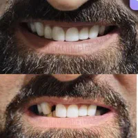 دندان سرامیکی طرح لمینت تحویل چندساعته|خدمات آرایشگری و زیبایی|محلات, |دیوار