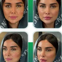 جشنواره بوتاکس پی ار پی مزوتراپی