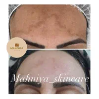 فیشال،آلگاپیل(پوست مار)هایفوتراپی،پوست کره ای|خدمات آرایشگری و زیبایی|قم, دورشهر|دیوار