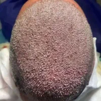 کاشت مو با بالا ترین تراکم و نازلترین قیمت