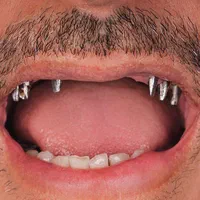 دندانپزشکی ایمپلنت کامپوزیت لمینیت روکش دندان|خدمات آرایشگری و زیبایی|تبریز, |دیوار