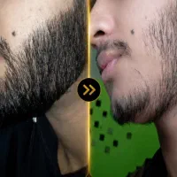 سرم. رویش.و حجم آوری. مو. ۳۵روزهه