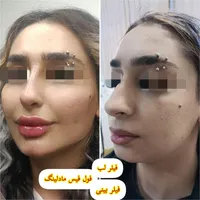 جشنواره تخفیف بوتاکس/ژل/آنزیم‌بینی/فیلرلب/فولفیس|خدمات آرایشگری و زیبایی|شیراز, زرهی|دیوار