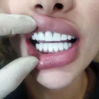 خدمات ویژه کامپوزیت ودندنسازی باقیمت ویژه|خدمات آرایشگری و زیبایی|یاسوج, |دیوار