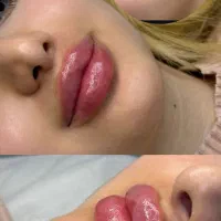 ب چند مدل برای ژل و بوتاکس نیازمندیم سیسی 800