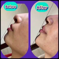 بوتاکس/پی آر پی/ژل لب/لیزر /مسکن|خدمات آرایشگری و زیبایی|کرمانشاه, |دیوار