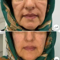 کرم گلدن کویین رفع لک بارداری وافتاب سوختگی  اصلی|آرایشی، بهداشتی، درمانی|کرمانشاه, |دیوار