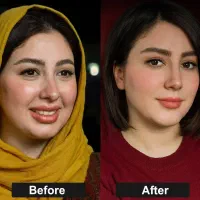 کرم جوانسازی و لیفت کننده صورت