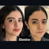 تزریق ژل بوتاکس فیلر در کلینیک زیبایی تهران|خدمات آرایشگری و زیبایی|تهران, یافت آباد جنوبی|دیوار