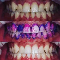 تخفیف وام دندانپزشکی ایمپلنت کامپوزیت روکش عصب کشی|خدمات آرایشگری و زیبایی|بروجرد, |دیوار