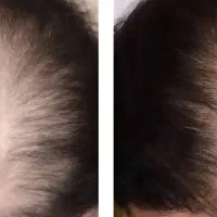 مزوتراپی و پی آر پی مو و ابرو|خدمات آرایشگری و زیبایی|اردبیل, |دیوار