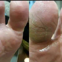 کرم ترک پاشنه پا