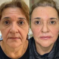 مرکز تخصصی خدمات ژل لب و بوتاکس فیلر بادی،آنزیم