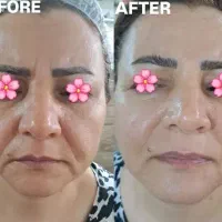 جشنواره لیفت/جوانسازی/انواع هایفو/در1جلسه فقط ۸۹۰ت|خدمات آرایشگری و زیبایی|اصفهان, ناژوان|دیوار