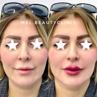 مدل تزریق فیلر و بوتاکس مزوژل انزیم توسط پزشک۸۹۹|خدمات زیبایی و سلامت|تهران, نارمک|دیوار