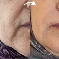 آنالیز ودرمان ریشه ای علت جوش ولک واسکار