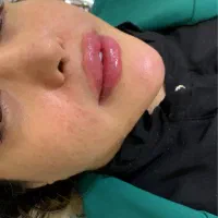 ژل/بوتاکس/مزو ژل/وآموزش|خدمات آرایشگری و زیبایی|خرمشهر, |دیوار