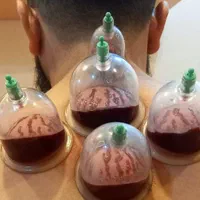 حجامت، درمان چسبندگی عصب دست، کبد چرب|خدمات آرایشگری و زیبایی|زاهدان, |دیوار