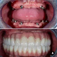 ثبت نام بیمه دندانپزشکی وکامپوزیت وزیبایی دندان|خدمات آرایشگری و زیبایی|گرگان, |دیوار
