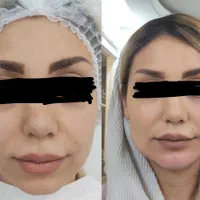 تزریق فیلر بوتاکس و لیفت افتادگی صورت و چشم|خدمات آرایشگری و زیبایی|شیراز, عفیف‌آباد|دیوار