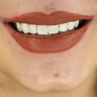 ایمپلنت لمینت ونیر و‌خدمات دندانپزشکی