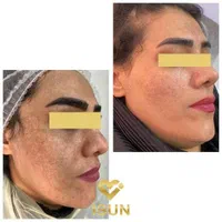 پاکسازی کل صورت ،رفع کک ومک آقایان وخانم ها دوجلسه|خدمات آرایشگری و زیبایی|تبریز, |دیوار
