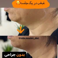 آف لاغری و پیکرتراشی بدون جراحی *