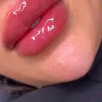 مدل ژل لب وبوتاکس فیلروغیره