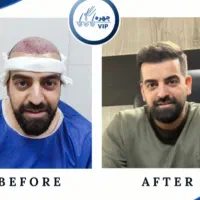 کاشت مو پرتراکم