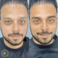 میکروبلیدینگ ابرو استایل آقایان و رفع تیرگی لب