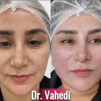 تخفیف ویژه لیفت و جوانسازی صورت|خدمات آرایشگری و زیبایی|مشهد, چهارچشمه|دیوار