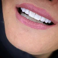 کامپوزیت دندان ، اصلاح طرح لبخند ، لمینت|خدمات آرایشگری و زیبایی|تهران, نظامی گنجوی (توانیر)|دیوار
