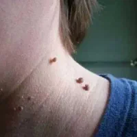 دستگاه خال برداری وزگیل برداری حتی جا های حساس|آرایشی، بهداشتی، درمانی|آبادان, |دیوار