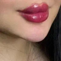 ت تزریق ژل لب /بوتاکس /فول فیس / هایفو /بلفارو