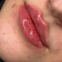 تخفیف فیلروبوتاکس مزو،درمطب پزشک|خدمات آرایشگری و زیبایی|سنندج, |دیوار