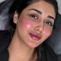 تزریق ژل،بوتاکس،فیلر،مزوتراپی،پی آر پی لیزر  هایفو|خدمات آرایشگری و زیبایی|اردبیل, |دیوار