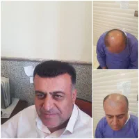 کاشت مو تضمینی واقساط