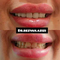 لمینت و کامپوزیت فوق حرفه ای در دندانپزشکی بینظیر|خدمات آرایشگری و زیبایی|شیراز, ملاصدرا|دیوار