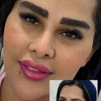 میکرو کاشت و روش جراحی اف ۵۰ درصدی