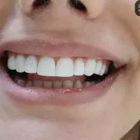 زیبایی دندان