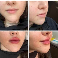 آموزش تزریق فیلر،بوتاکس و مزوولیفت با نخ توسط پزشک