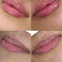 مطب زنان لابیاپلاستی غبغب بوکالفت تزریق چربی|خدمات آرایشگری و زیبایی|تهران, عبدل‌آباد|دیوار