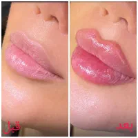 تخفیف به مناسبت روز مادر /ژل لب- کانتورینگ- بوتاکس|خدمات آرایشگری و زیبایی|مشهد, ایثار|دیوار