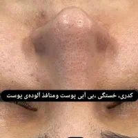 فشیال تخصصی پوست|خدمات آرایشگری و زیبایی|مرند, |دیوار