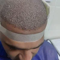 بیا اقساطی مو بکار کاشت مو و ابرو و ریش تضمینی|خدمات آرایشگری و زیبایی|ارومیه, |دیوار