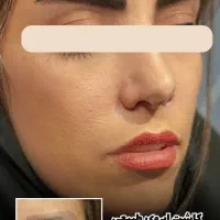 کاشت مو و ابرو / بوتاکس / چربی ژل /کلینیک /زیبایی|خدمات آرایشگری و زیبایی|بوکان, |دیوار